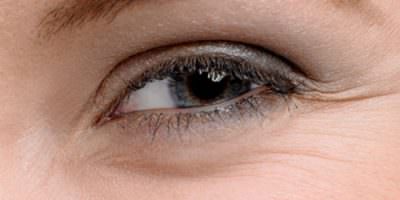 tipos de arrugas del ojo