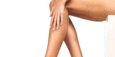 varices en las piernas